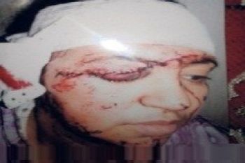 هروب متهم بمكناس شَوَّهَ وجه والدة خطيبته لفسخها الخطوبة