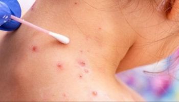 وزارة الصحة تعلن تسجيل ثلاث حالات يشتبه في إصابتها بجذري القرود وتنفي تسجيل حالات مؤكدة