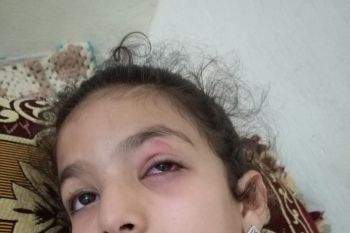 بالصور : إصابة تلميذة بجرح خطير في العين بعد تعنيفها من طرف معلمتها والمديرية تتدخل