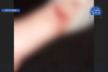 مص ر ع شخص بحي النعيم بمكناس بعد تعرضه لهجو م كلاب ضالة ومكتب حفظ الصحة في سبات